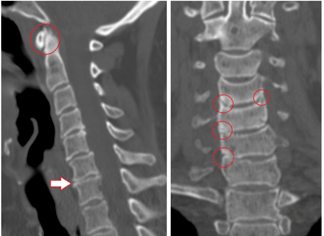 Le scanner montre des vertèbres et des disques endommagés de hauteur hétérogène en raison d'une ostéochondrose thoracique
