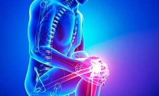 stades d'arthrose de l'articulation du genou