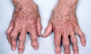 comment distinguer l'arthrite des doigts de l'arthrose
