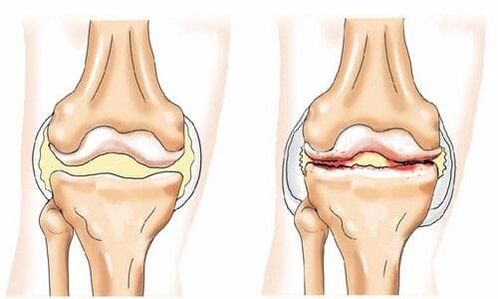 articulation du genou saine et atteinte d'arthrose