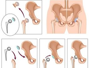 endoprothèses pour l'arthrose de la hanche